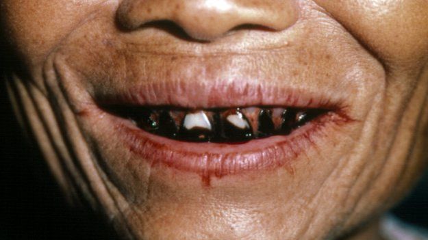 Trầu cau và cái chết âm thầm ảnh 4