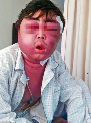 Đầu sưng như quả bóng suốt 2 tháng vì… muỗi đốt ảnh 1