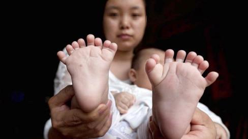 Bé trai có 31 ngón tay, chân ảnh 1