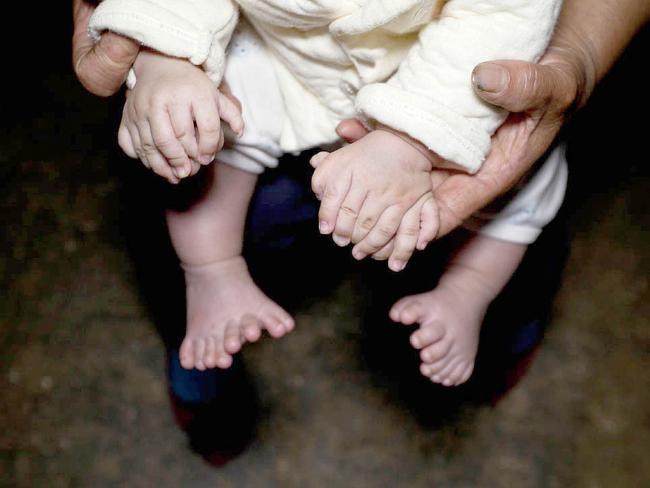 Bé trai có 31 ngón tay, chân ảnh 2