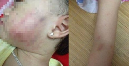 Bé gái bị thâm tím mặt ở trường mầm non ảnh 1