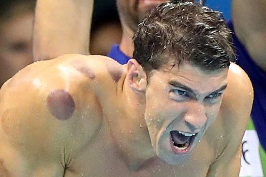Cơ thể đầy vết bầm giác hơi của hàng loạt VĐV Olympic ảnh 3