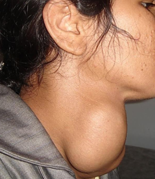 Khám, tư vấn miễn phí cho người bị bướu giáp nhân ảnh 1