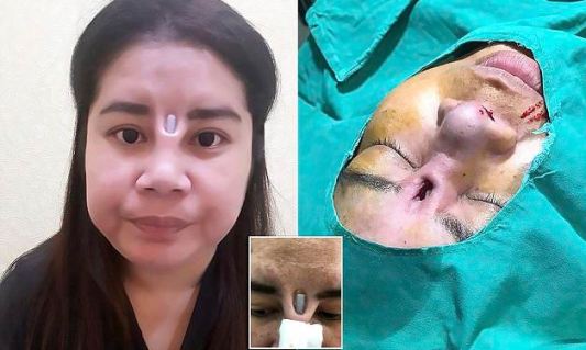 Làm đẹp giá rẻ, người phụ nữ bị que nâng mũi lòi ra ngoài ảnh 1