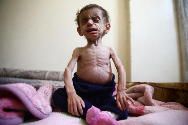 Một em bé bị suy dinh dưỡng nghiêm trọng tại khu vực do lực lượng nổi dậy Syria kiểm soát.