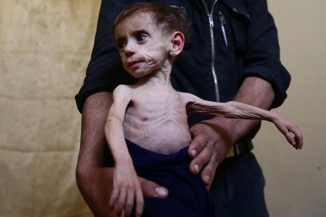 Bức ảnh về những em bé suy dinh dưỡng phóng viên ảnh Bassam Khabieh của Reuters chụp lại.