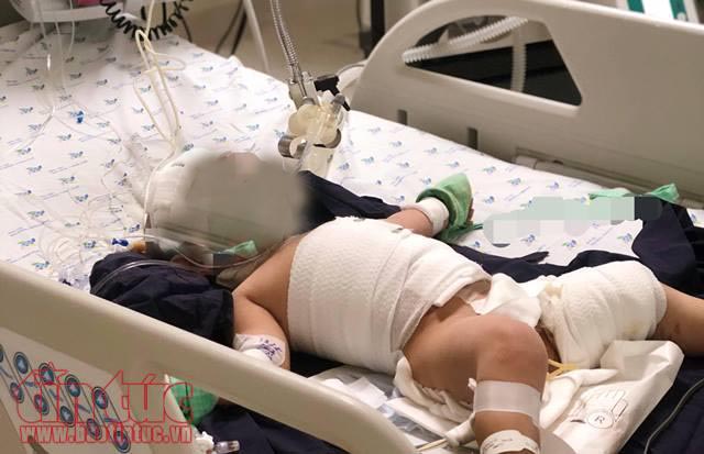 Bé gái 20 tháng tuổi bị bỏng nặng khi vấp dây điện ấm đun siêu tốc ảnh 1