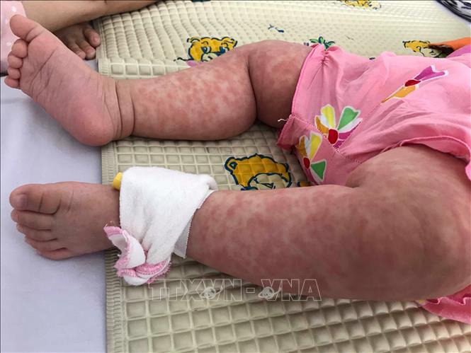 Nghệ An ghi nhận 1.210 ca nghi sởi